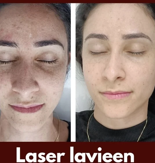Registro de depilação a laser
